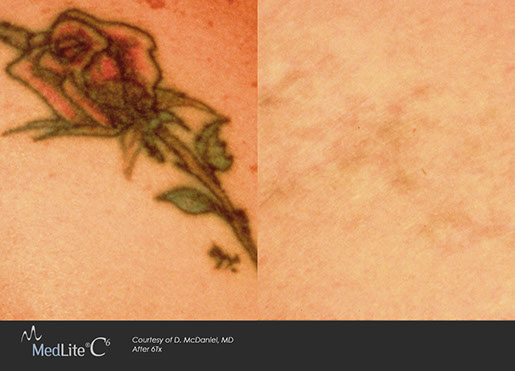 Tattoo Removal | Lucky Lime Clinic | Orangeville, Ontario