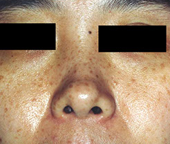 before medlite_jinanclinic_1