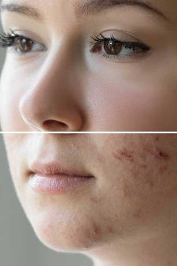 Skin Rejuvenation